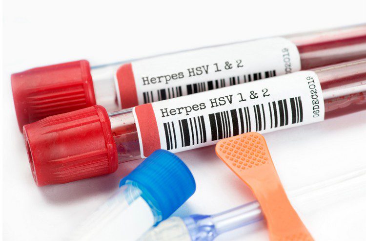Life With Genital Herpes | Broadgate GP