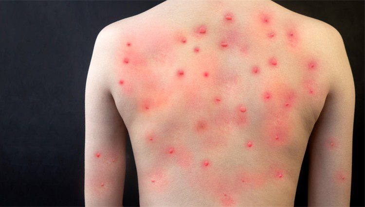 Monkeypox: Is It an STI? | Broadgate GP