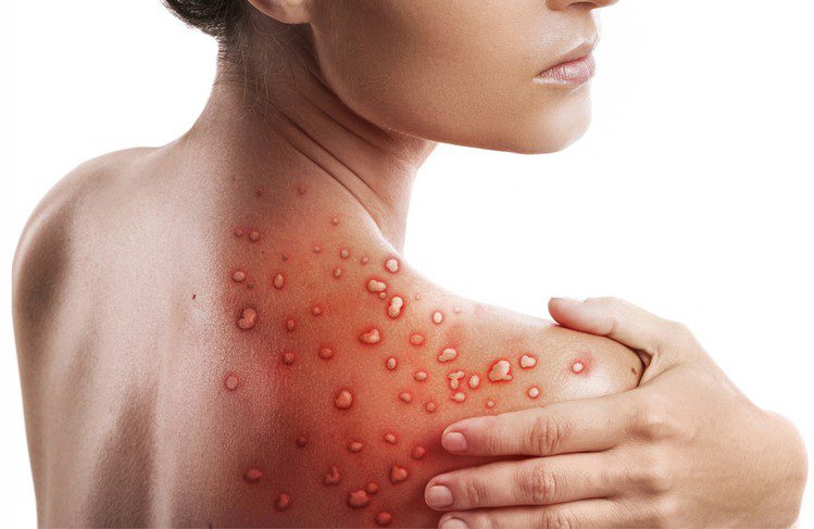 Monkeypox: Is It an STI? | Broadgate GP