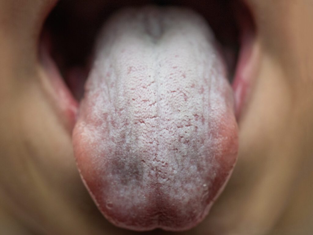thrush symptom on tongue